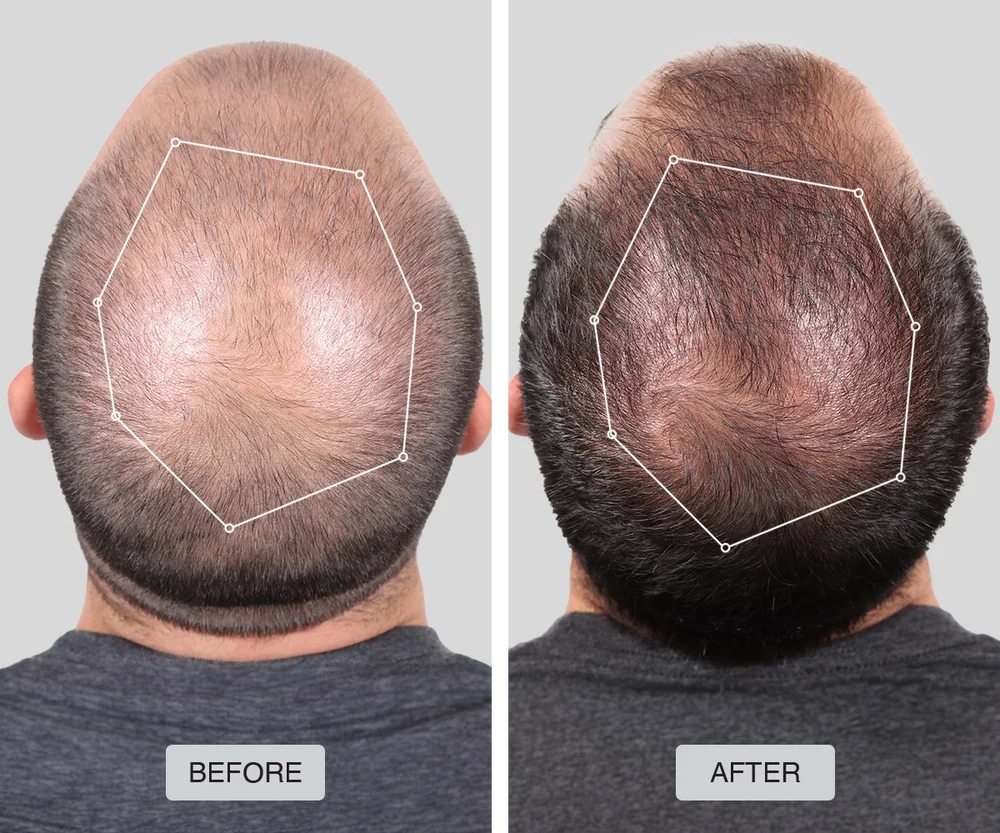 LumiFolix Pro: Laser Hair Growth Cap.