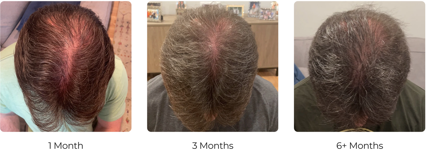 LumiFolix Pro: Laser Hair Growth Cap.