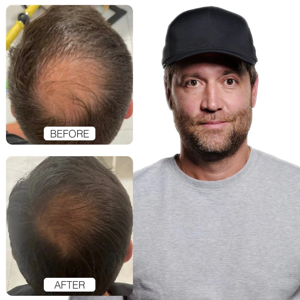 LumiFolix Pro: Laser Hair Growth Cap.